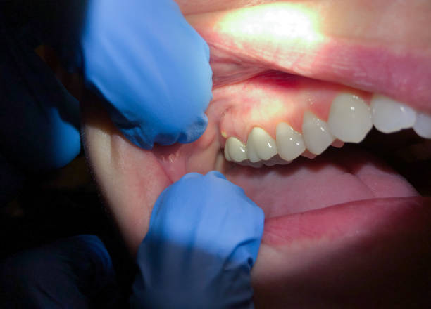 Best Emergency Care for Gum Disease in Greendale, IN